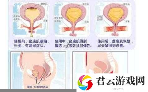 3d 生物束带紧缩术能维持几年:效果影响因素与个体差异分析